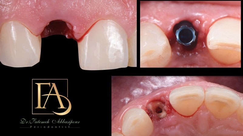 ایمپلنت فوری