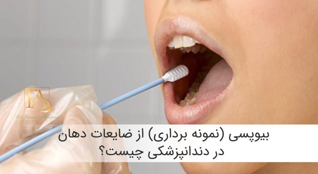 بیوپسی (نمونه برداری) از ضایعات دهان