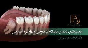 دندان نهفته