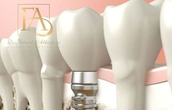 پیوند استخوان