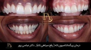 رفع سیاهی لثه ها