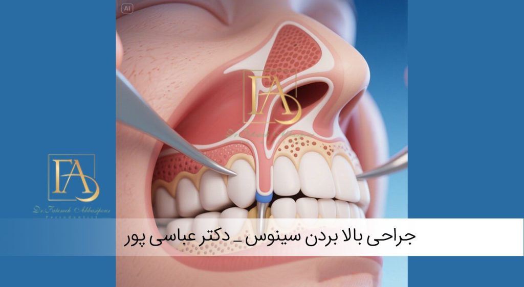 جراحی بالا بردن سینوس
