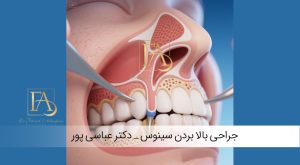 جراحی بالا بردن سینوس