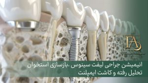 جراحی لیفت سینوس