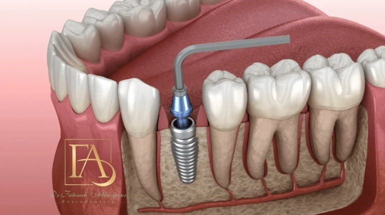 ایمپلنت فوری