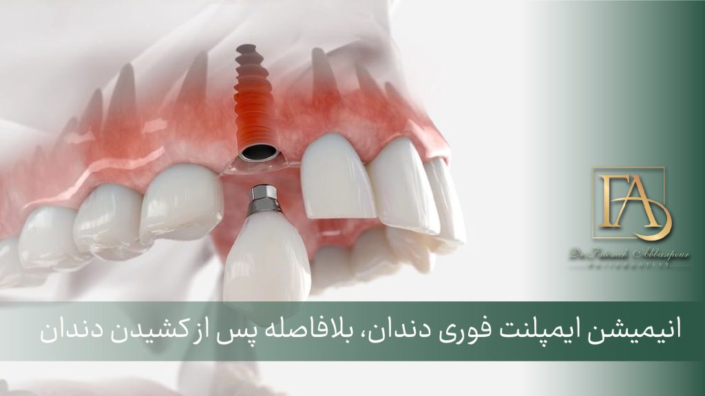 ایمپلنت فوری دندان